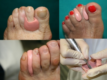 Luca Rinaldi,ortesi su misuta