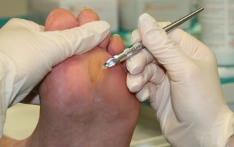 calli modena,asportazione callosità,asportazione calli